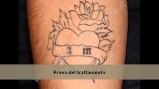 Rimozione Tatuaggio Milano foto Prima e Dopo [upl. by Naj666]