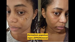 Dermatosis papulosa nigra DPN Removal [upl. by Roberta]