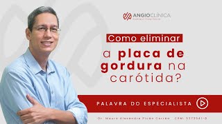 Como eliminar a placa de gordura na carótida [upl. by Konstantine]