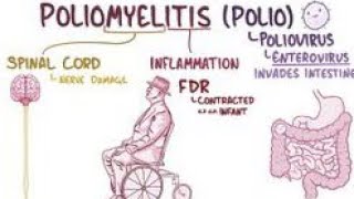 Poliomyelitis  Introduction of poliomyelitis  Causes of poliomyelitis  Type of poliomyelitis [upl. by Osman]