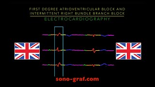 Electrocardiography  First Degree Atrioventricular Block And Intermittent Right Bundle Branch Block [upl. by Nellie]