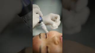 Microneedling Session with Nurse Miki Rejuvenate Your Skin 🌟 [upl. by Balfore969]