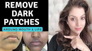 Hyperpigmentation Around Mouth Remedy I मुँह के आस पास कालापन  कारण  इलाज [upl. by Ikiv]