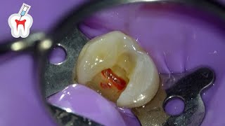 Live Premolar Root Canal Procedure [upl. by Eustashe]