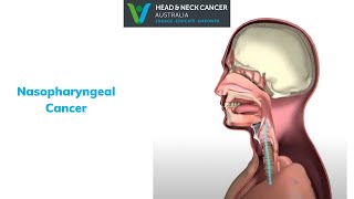 Nasopharyngeal Cancer  What Is It What are the Symptoms and Treatment Head and Neck Cancer [upl. by Wynny]