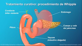 Cáncer de páncreas tratamiento y resultados [upl. by Emmi605]