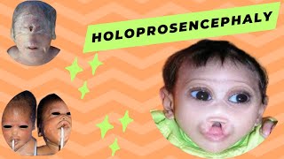 Holoprosencephaly  Causes  Symptoms  Diagnoses and Treatement [upl. by Lindeberg]