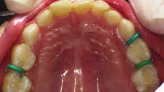 Hall’s Technique Demonstration of Placing a Stainless Steel Crown in a Primary tooth [upl. by Ahsikyw]