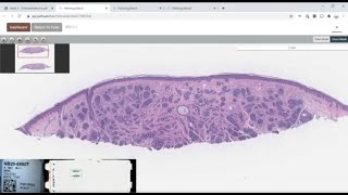 Trichoepithelioma [upl. by Missie]