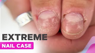 Short Nails Transformation  How to Remove Sensitive Cuticle [upl. by Harbard760]