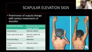 Sprengel Shoulder  Dr Gopa Kumar [upl. by Onstad]