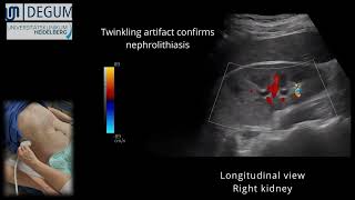 Episode 39 NephroUrolithiasis [upl. by Ekul]