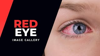 Red Eye Image Gallery [upl. by Ardnasac283]