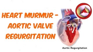 Aortic Regurgitation Auscultation Sound [upl. by Amirak]