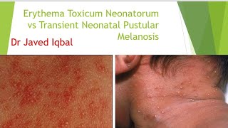 Erythema Toxicum Neonatorum VS Transient Neonatal Pustular Melanosis [upl. by Stromberg746]