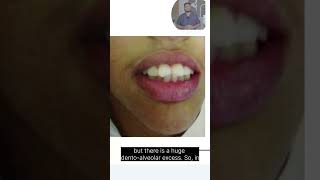 Class 1 Malocclusion Part 3  Bimaxillary Protrusion keepitsnazzy [upl. by Htiek]