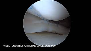 Repair of Bucket Handle Medial Meniscus tear with circumferential suturing all inside Novostitch [upl. by Toolis]