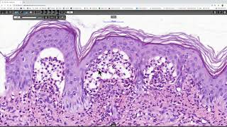 Dermatitis herpetiformis Phillip H McKee Antonina Kalmykova CSD Health Care [upl. by Yordan]