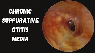 Chronic Suppurative Otitis Media  Part 1  Tubotympanic Type Of CSOM [upl. by Eirot]