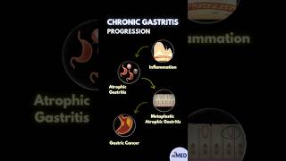 Progression of Chronic Gastritis minuteMED gastritis chronicgastritis [upl. by Broderick]