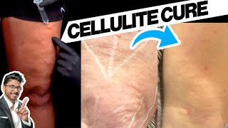 How To Get Rid Of Celulite  Removal Sunekos Cell [upl. by Retlaw112]