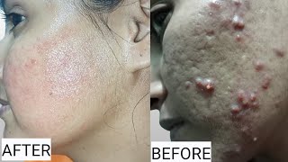 Tretinoin Cream Routine [upl. by Anneres]