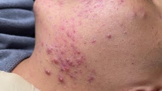 Blackheads amp Pimples Pore Removal New 2024FULL  Acne Treatment With Bo Nguyễn Spa [upl. by Herson]