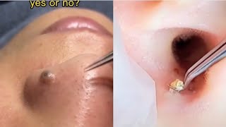 Ultimate Pimple Popping Compilation 2024 Satisfying Cyst amp Blackhead Removal [upl. by Elitnahc]