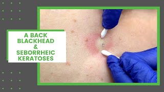 A Back Blackhead amp Seborrheic Keratoses  Dr Derm [upl. by Gauntlett]