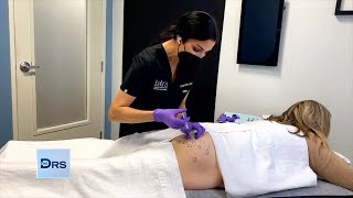 FDAApproved Cellulite Injection for Women [upl. by Kimitri]