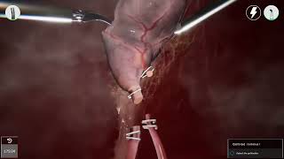 LAPAROSCOPIC CHOLECYSTECTOMY  Gallbladder removal  3D simulation 👩🏽‍⚕️ [upl. by Anirroc745]