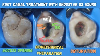 Root Canal Treatment 🟠 Maxillary First Permanent Molar 🔵 Endostar E3 Azure 🟡How to find Mb1 amp Mb2 [upl. by Ayanat]