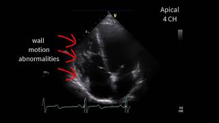 A special cardiomyopathy [upl. by Arit587]