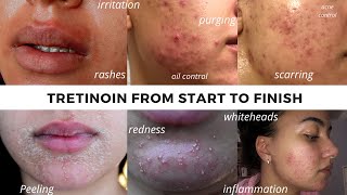 TRETINOIN BEFORE AND AFTER  FULL TRETINOIN EXPERIENCE my journey from start to end Adult Acne [upl. by Ennybor]