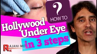 Under Eye Filler Injections For Dark Circles and Bags  PRF Filler Injections Before and After Pics [upl. by Katharyn953]