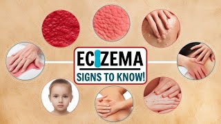 quotEczema Explained Symptoms Causes amp Treatmentsquoteczema skincare [upl. by Mizuki]