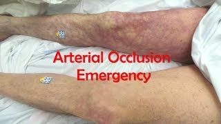 Acute Complete Occlusion of the Leg Arteries [upl. by Tivad]