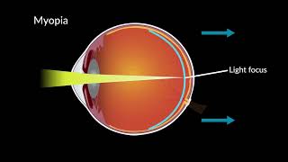 Myopia and Eye Development [upl. by Eluk]