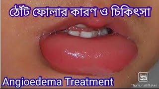 ঠোঁট ফোলার কারণ  ঠোঁট ফোলা কমানোর উপায়  Angioedema Treatment [upl. by Brace]