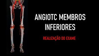 Angiotomografia Membros Inferiores REALIZAÇÃO DO EXAME [upl. by Nairred]