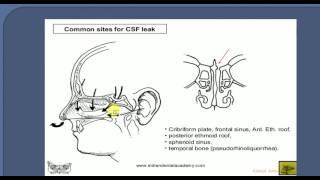 ENT LECTURES  CSF RHINORRHEA [upl. by Onez]