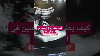 كيف يظهر نوع الجنين في السونار échographie؟؟ حمل حامل baby [upl. by Craggie28]