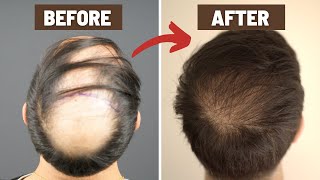 1 Year CROWN Hair Transplant Journey  Before amp After Trust The Process [upl. by Alderson]