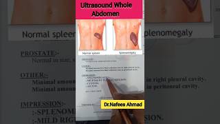 Ultrasound Whole Abdomen Cystitis doctor ultrasound mbbsdoctor bums doctorsdream [upl. by Yeliah]