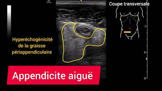 Appendicite aiguë Échographie Appendicitis [upl. by Jezabelle]