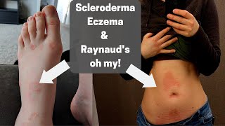 Scleroderma My story so far [upl. by Atiloj]