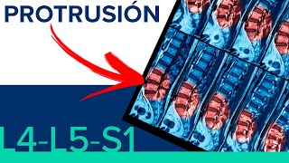 PROTRUSION L4L5 y L5S1 😤 ¿Hernia de disco o protrusion discal [upl. by Herc]