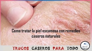 Como tratar la piel escamosa con remedios caseros naturales [upl. by Anomor]