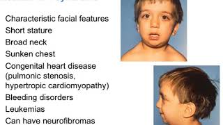 Genetics of Neurofibromatosis Present State and Future States [upl. by Neened]