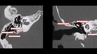 CT petrous temporal bone Surgeon vision  Cortical mastoidectomy preoperative checklist [upl. by Carter]